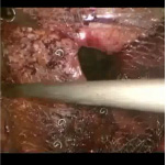laparoskopi videoları