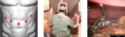 laparoskopi videoları