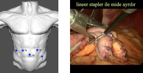 laparoskopi videoları