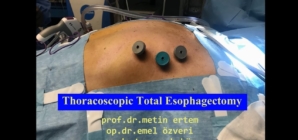 Torakoskopik total özofajectomi +laparoskopik gastrik rekonstrüksiyon