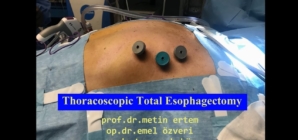 Torakoskopik total özofajectomi +laparoskopik gastrik rekonstrüksiyon