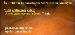 laparoskopik üç port kolesistektomi. edit edilmemiş video (7 dak.)