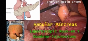 Annular Pancreas. Laparoscopic DuodenoJejunostomy