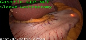 Gastric GEP-NET. Sleeve Gastrectomy