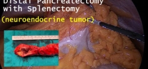 Laparoscopic Distal Pancreatectomy ( neuroendocrine tumor).
