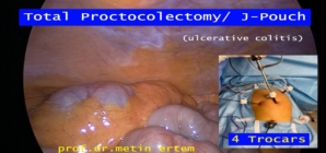 Total Proctocolectomy / J-Pouch.
